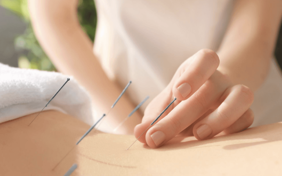 Close-up of an acupuncturist's hands inserting needles into a person's back during a wellness-focused acupuncture session.